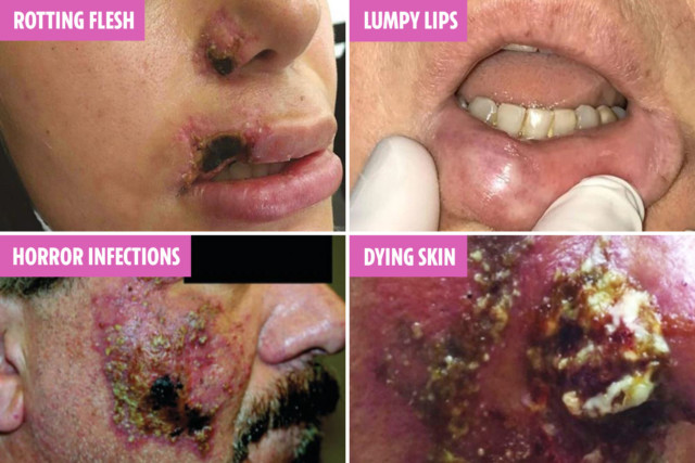 These are some of the horrific case reports we uncovered showing shocking cases of infection, rotting skin and lumps after having fillers