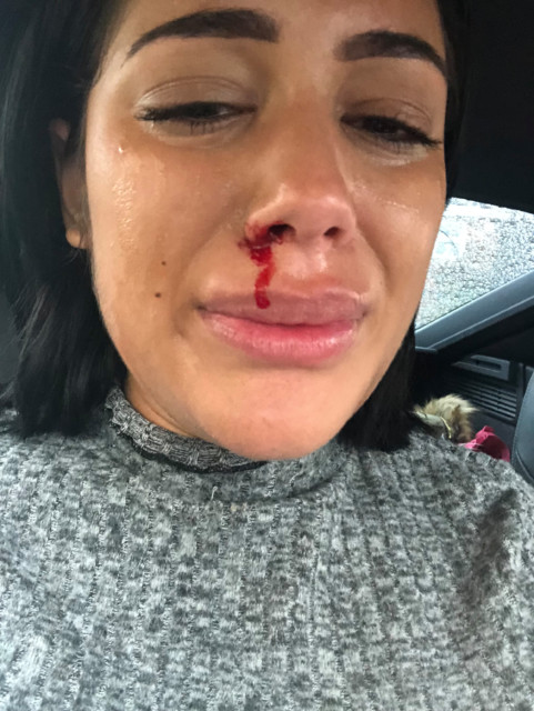 Malin shared a distressing image of her bloodied nose after an attack